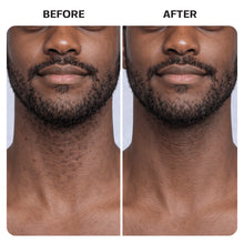 Load image into Gallery viewer, Razorburn/Ingrown Hair Roller Serum